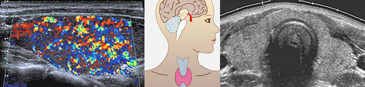 Schilddr&uuml;se Sonographie